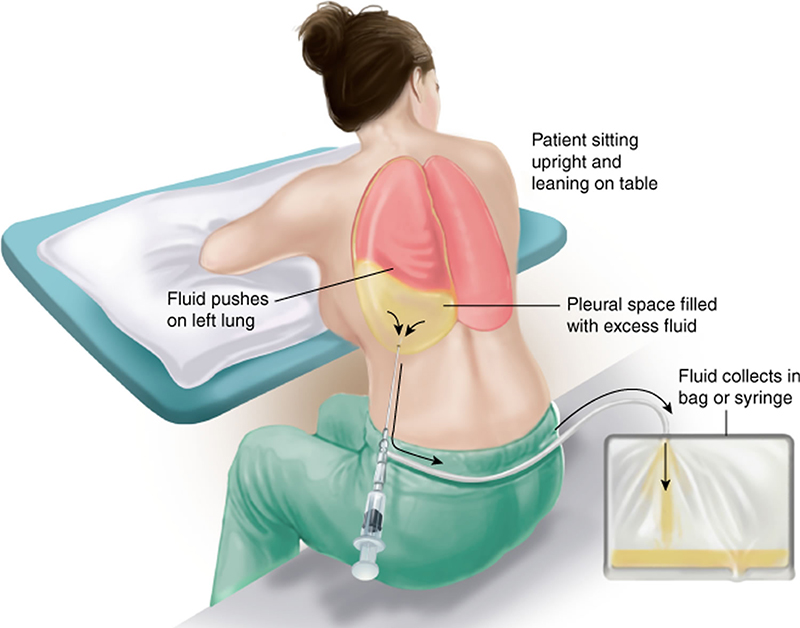 Chọc tháo dịch hoặc thực hiện mở màng phổi tối thiểu để dẫn lưu dịch, nhằm cải thiện tình trạng hô hấp của bệnh nhân